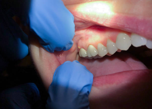 Best Emergency Denture Repair in Two Rivers, WI
